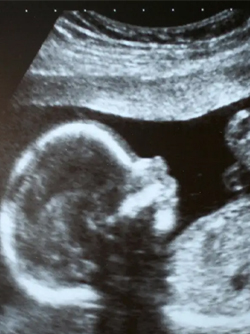 ultrasound scan